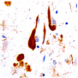 Tau-positive neurons (brown) in the hippocampus of a patient with Alzheimers disease dilution of 1:1000) using Fluorescein (FITC)-labeled anti-Chicken IgY(1:500 dilution, NeuromicsCatalog#:CH23101 ) as the secondary reagent.